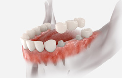 Digital illustration of a dental bridge