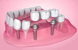 Digital illustration of an implant bridge