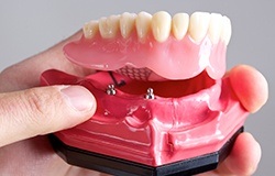 Model of implant supported denture