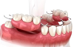illustration of a partial denture 