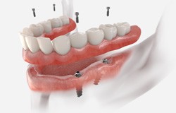 digital illustration of a dental implant denture   