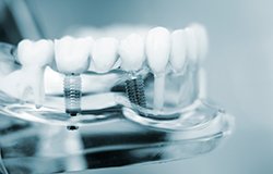 a model of a mouth with an implant bridge