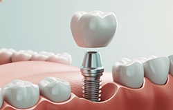 a computer illustration of an implant crown