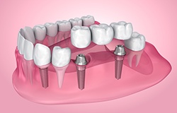 a computer illustration of an implant bridge
