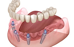 a computer illustration of an implant denture