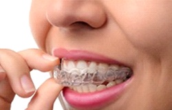 Woman inserting Invisalign in Orange Park