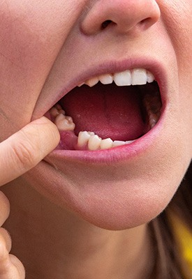 Woman missing a tooth