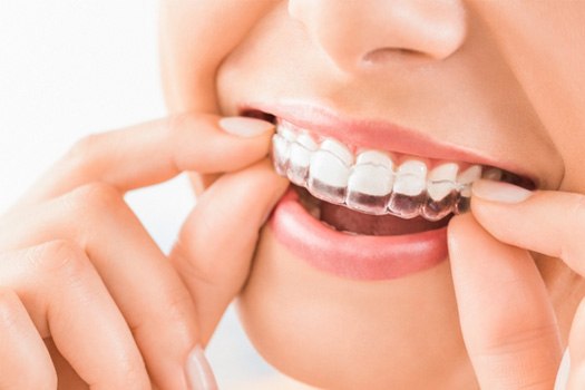 A woman putting on an Invisalign aligner