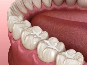 molars with tooth-colored fillings 3D illustration 