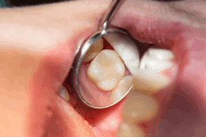 Dental mirror showing a tooth with a seamless tooth-colored filling